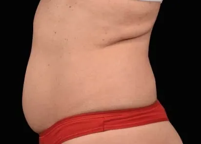 before emsculpt treatment in her belly