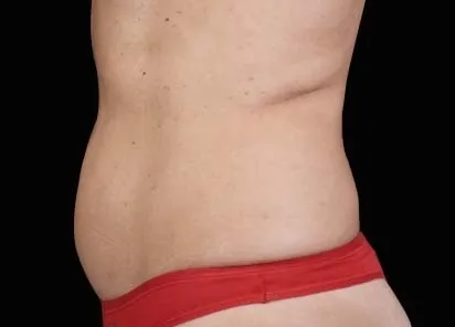 after one month of emsculpt treatment in her belly