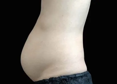 before emsculpt treatment in a man's belly