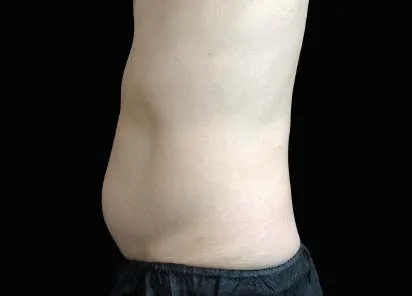 after 3 months of emsculpt treatment in a man's belly