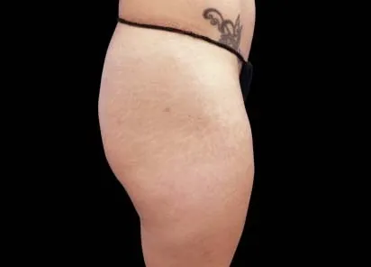 before emsculpt treatment in her buttocks and thighs