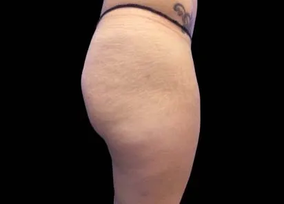 after 4 weeks of emsculpt treatment in her buttocks and thighs