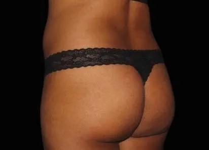 before emsculpt treatment in her buttocks