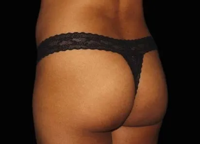 after emsculpt treatment in her buttocks