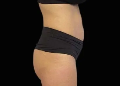 before emsculpt treatment in a woman's belly