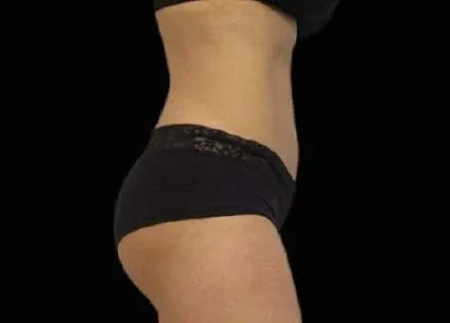 after 12 weeks of emsculpt treatment in a woman's belly
